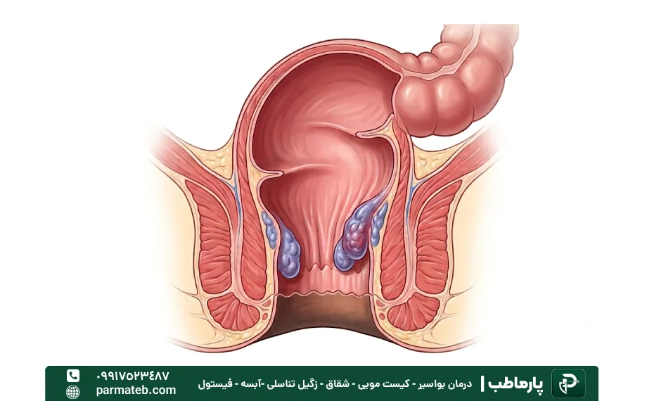 بواسیر یا هموروئید داخلی چیست