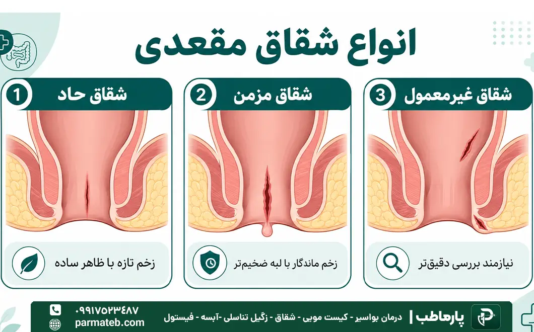 انواع شقاق مقعدی