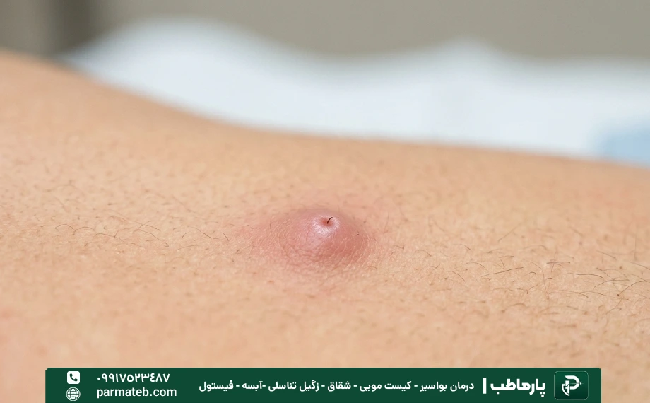 مهم ترین علائم کیست مویی