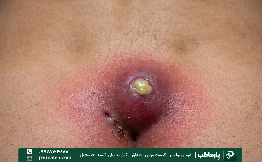آبسه از جمله خطرات کیست مویی است