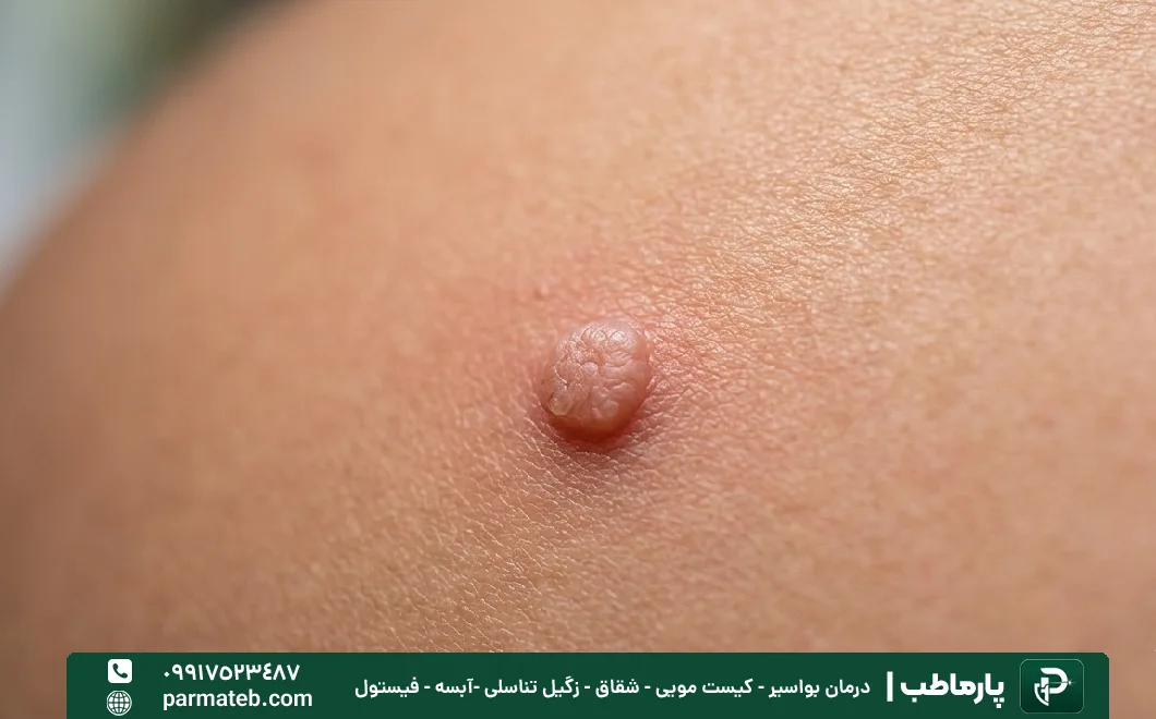 علائم اصلی زگیل تناسلی در مردان خارش است