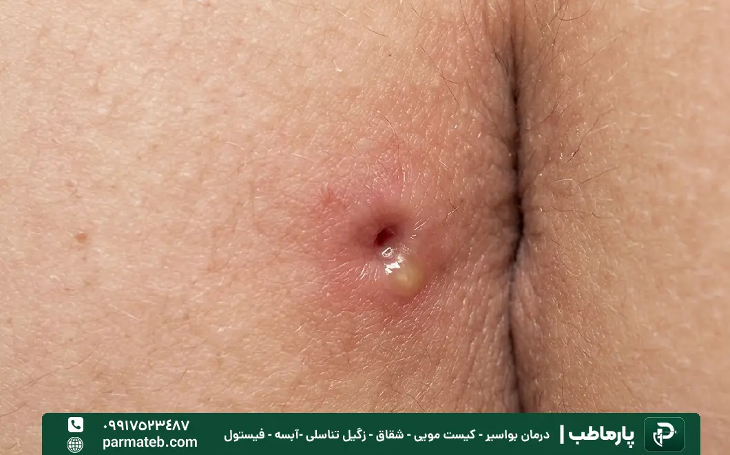 آبسه یکی از علت ایجاد فیستول مقعدی.webp