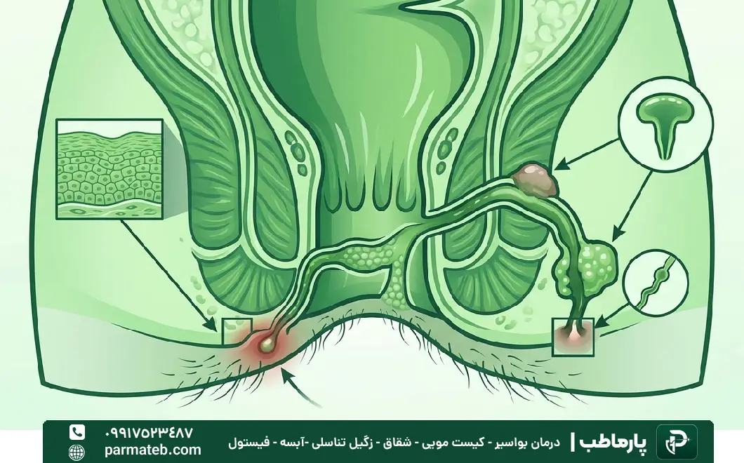 توضیح عملی ایجاد فیستول در بدن