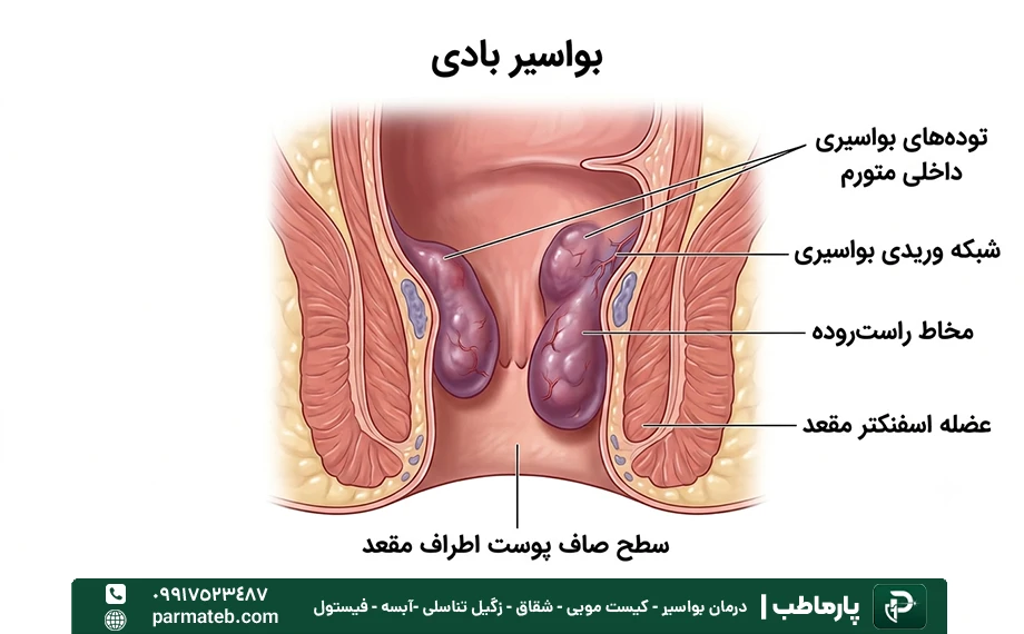 بواسیر بادی | علت علائم و درمان خانگی + عکس