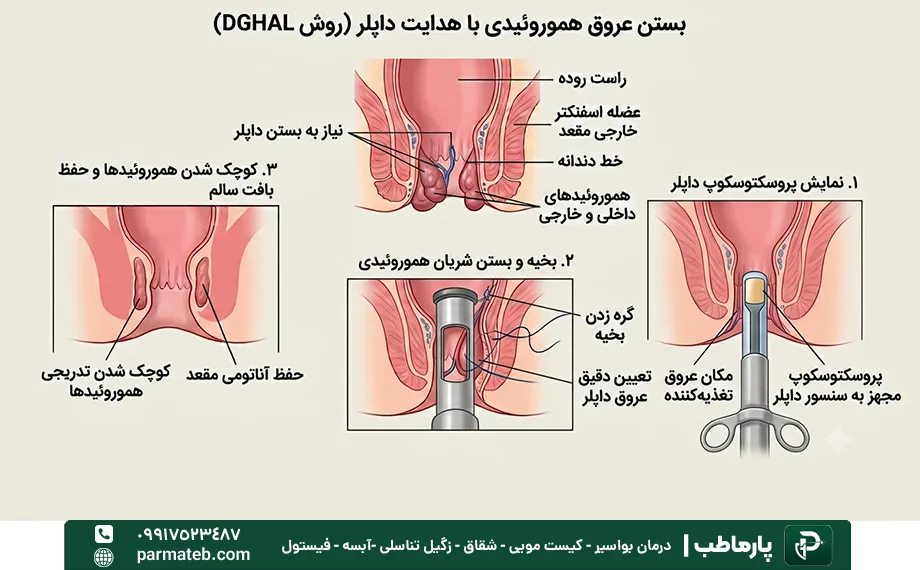 بستن هموروئید با هدایت داپلر