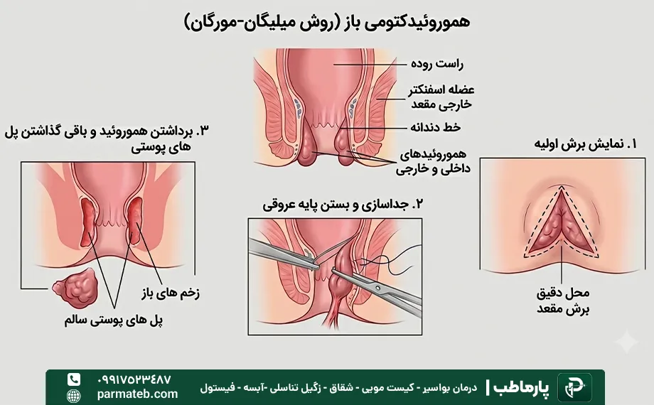جراحی هموروئیدکتومی باز