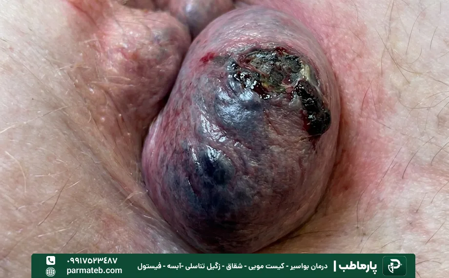 عکس هموروئید ترومبوزه.webp