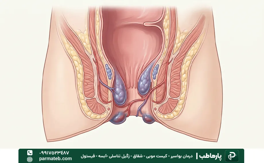 عکس بواسیر در کودکان.webp