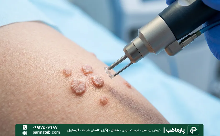 لیزر برای سوزاندن زگیل تناسلی