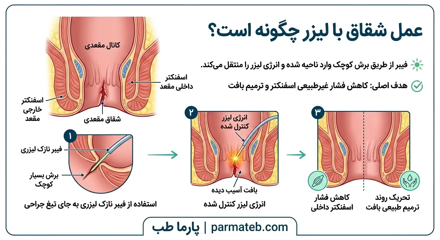 توضیح فرآیند عمل شقاق با لیزر