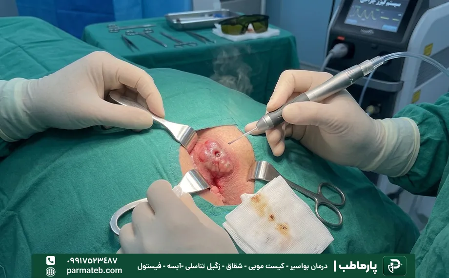 مراحل انجام لیزر آبسه مقعدی
