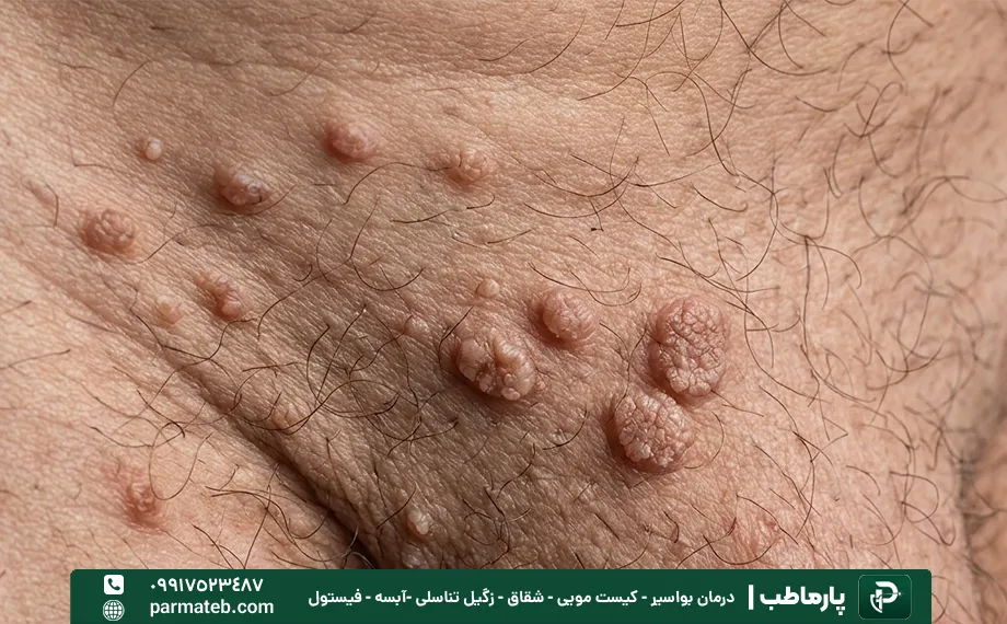 تشخیص زگیل تناسلی در مردان