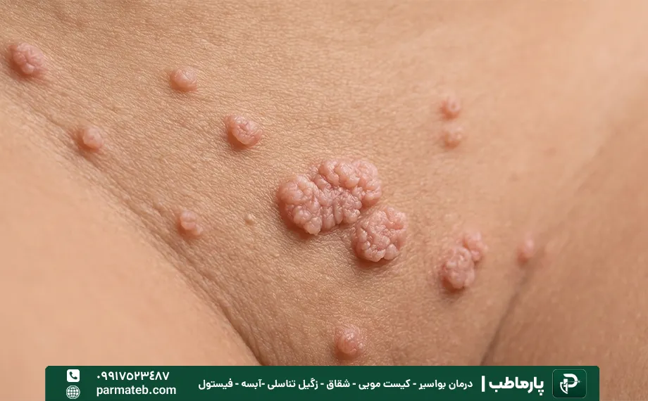 تشخیص زگیل تناسلی در زنان