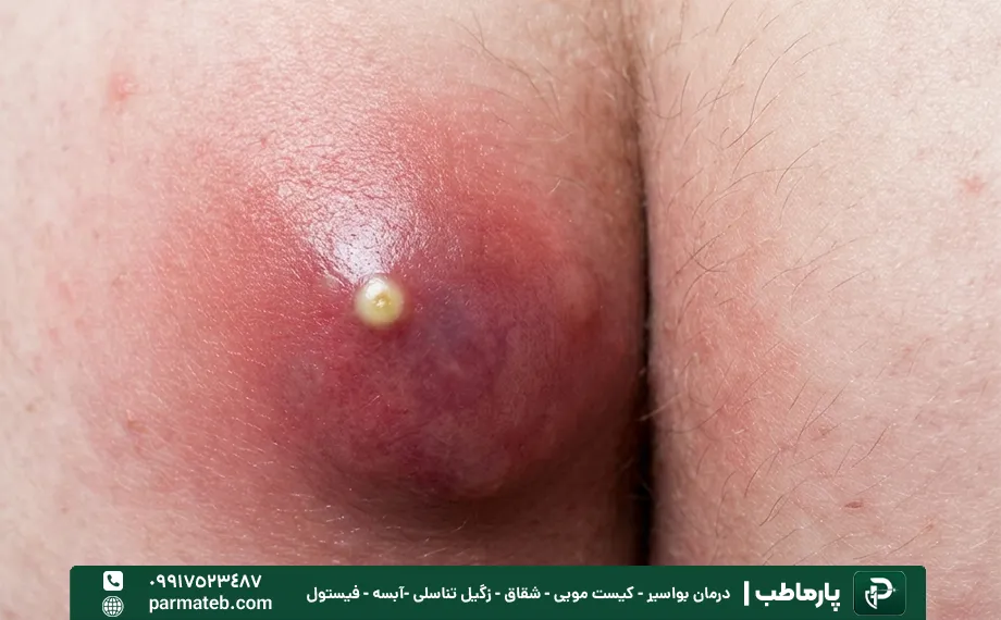 خود به خود خوب شدن آبسه مقعدی