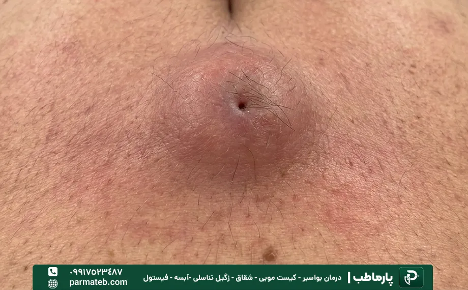 کیست مویی چه زمانی باید جراحی شود