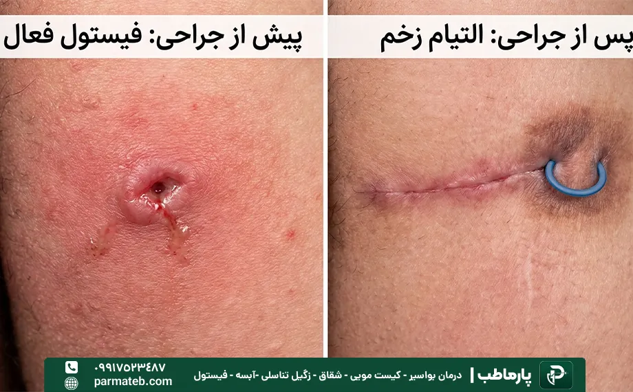 عکس بعد از عمل فیستول