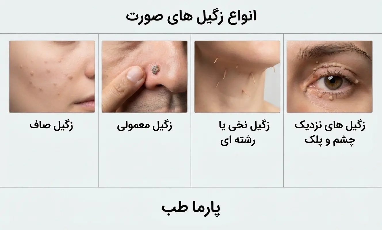 عکس انواع زگیل صورت.