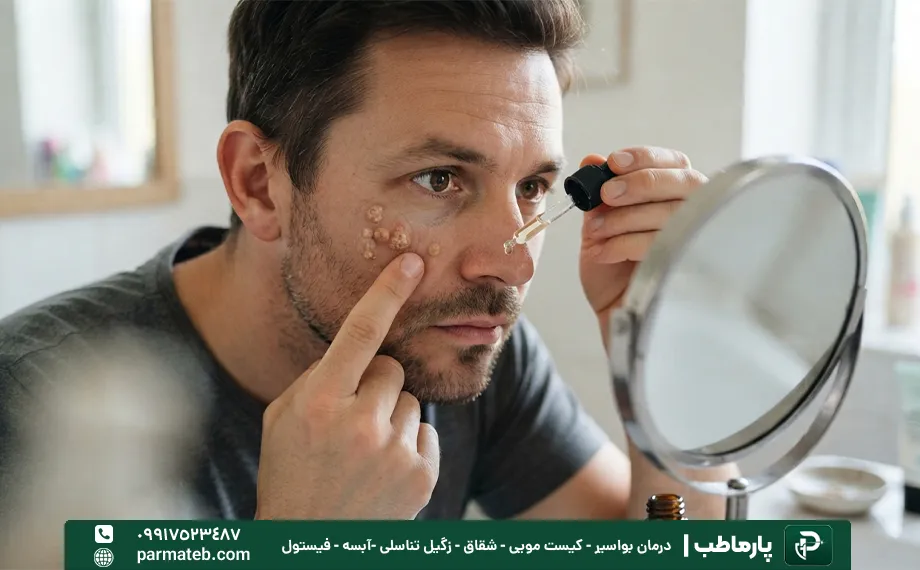 درمان خانگی زگیل صورت با روغن درخت چای