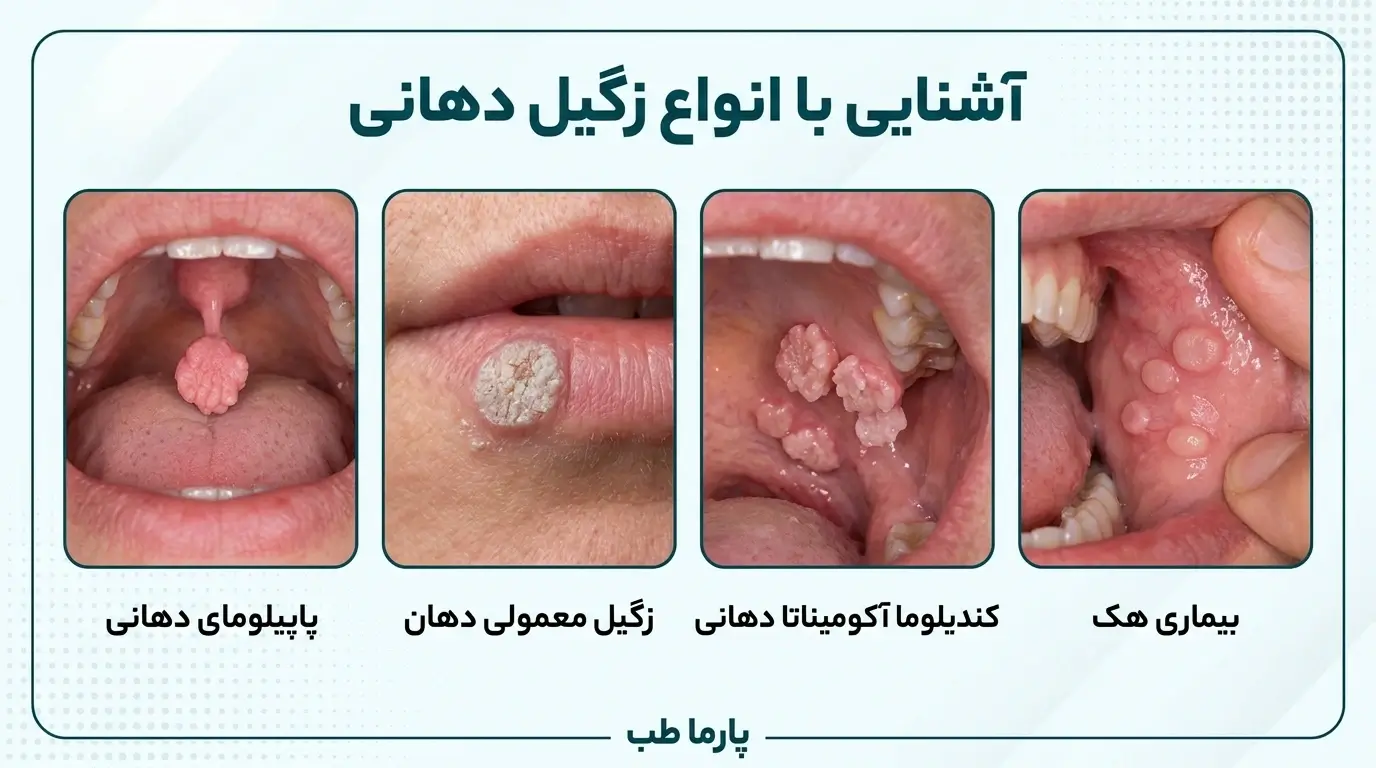 انواع زگیل دهانی