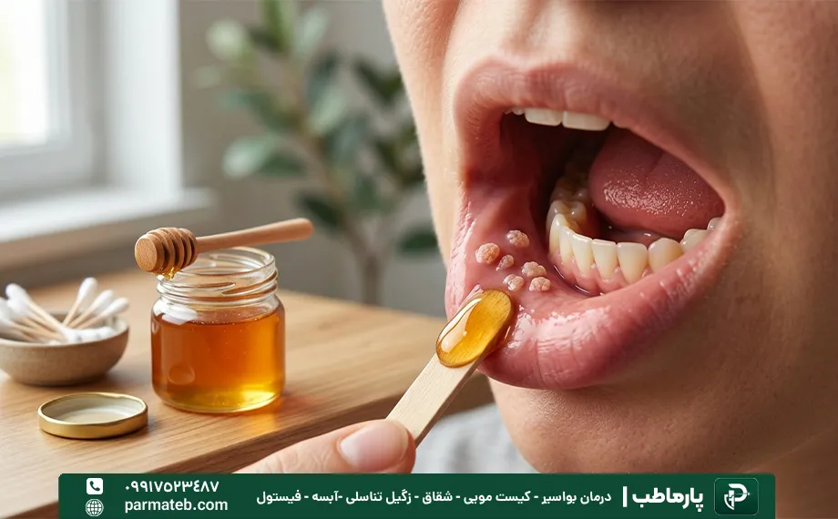 درمان زگیل دهانی با عسل