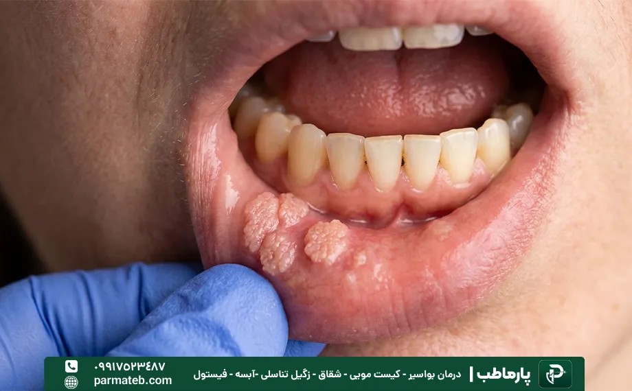 نشانه ها و علائم زگیل در دهان