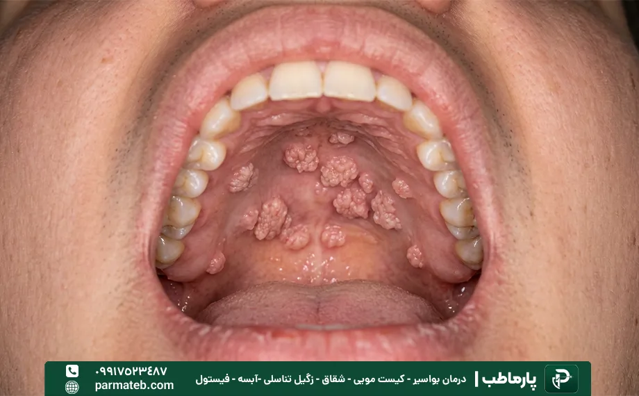 علت ایجاد زگیل دهانی.webp