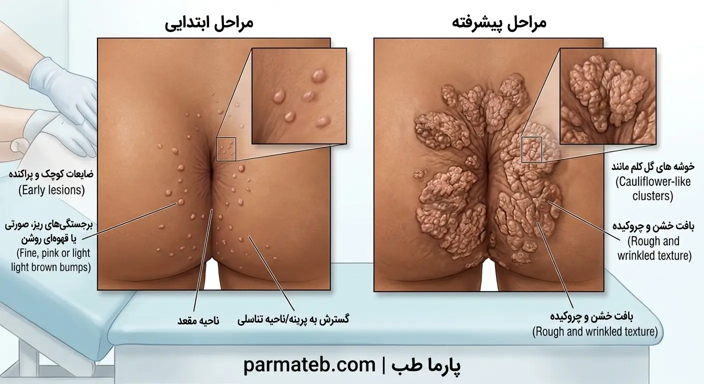 عکس زگیل مقعدی در زنان