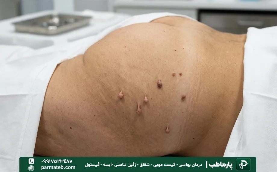 منگوله پوستی ناحیه تناسلی