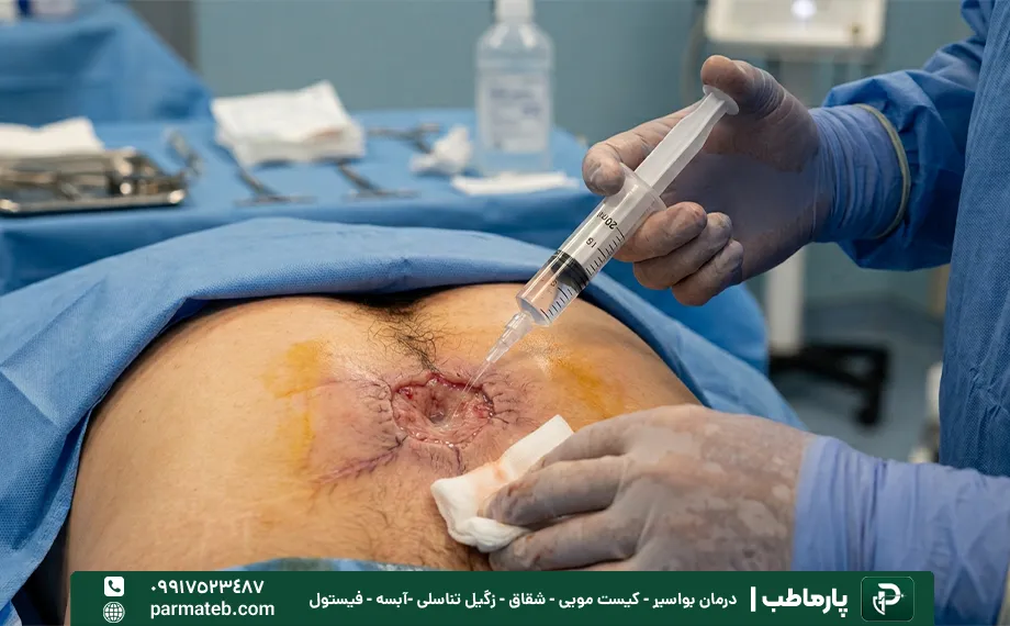 شستشوی کیست مویی