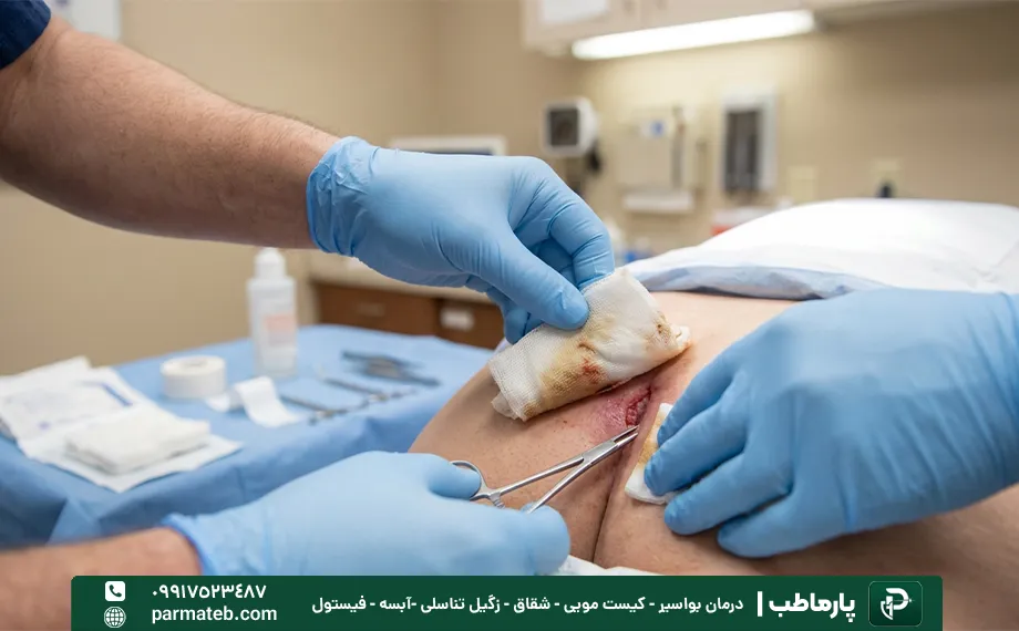 نحوه صحیح شستشو و پانسمان کیست مویی