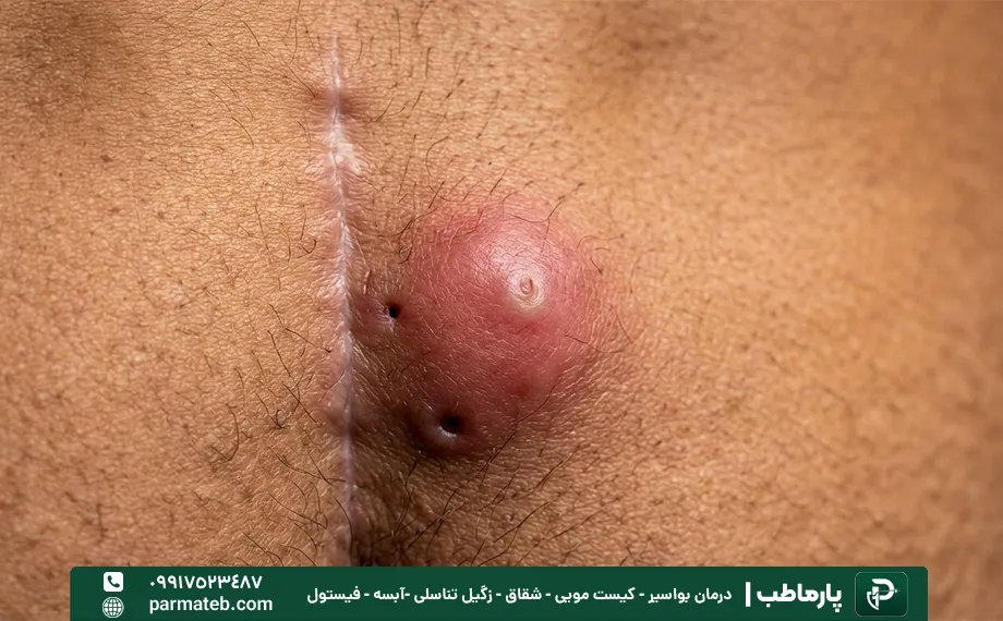 عکس کیست مویی عود کرده