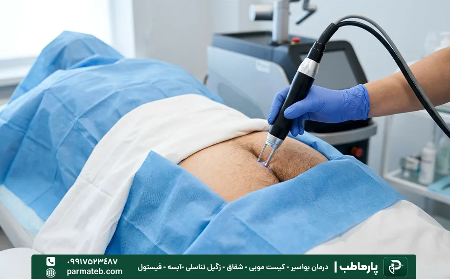 لیزر موهای زائد برای جلوگیری از عود کیست مویی