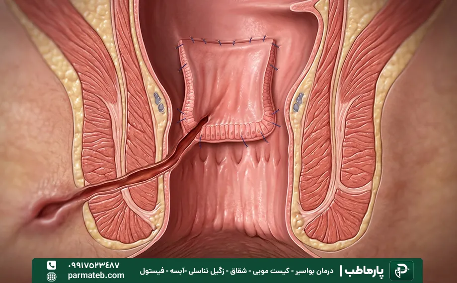 روش فلپ پیشرفته برای درمان عود فیستول مقعدی