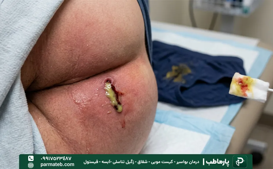 ترشحات نشانه و علائم بازگشت فیستول