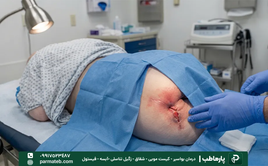 فیستول مقعدی در کودکان