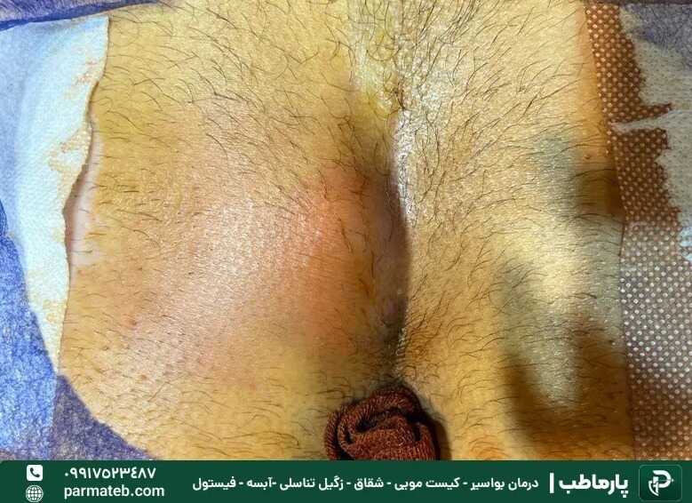 نوع کیست مویی