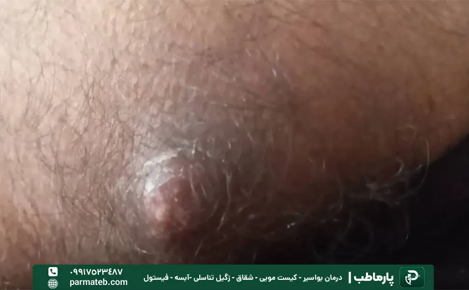 مسیر و عمق آبسه و اثر روی قیمت لیزر آبسه.webp