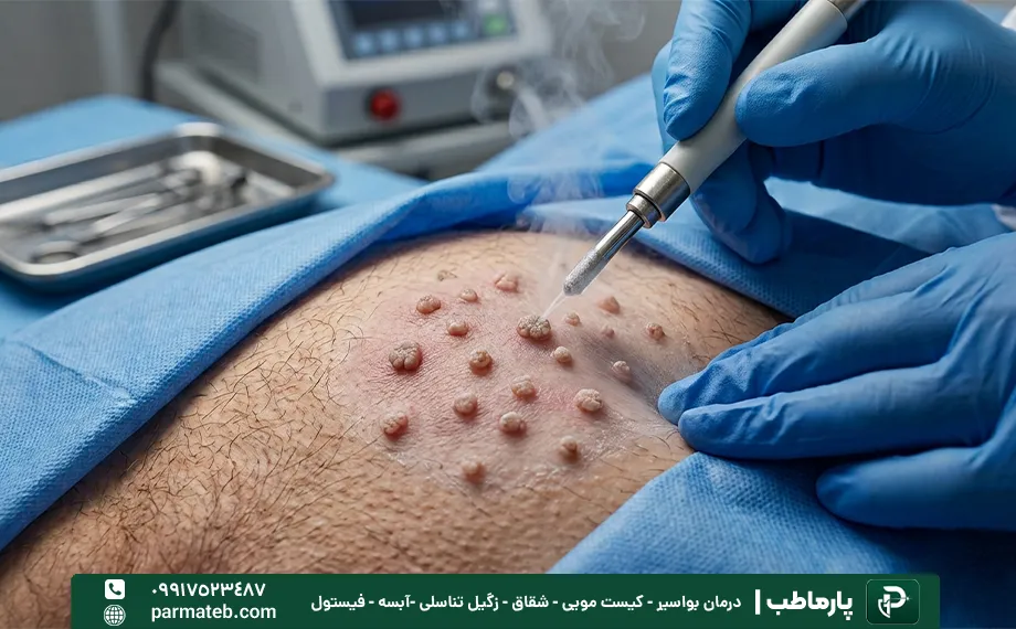تاثیر تعداد زگیل ها بر هزینه