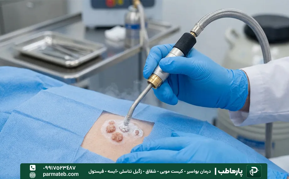 هزینه کرایوتراپی زگیل تناسلی