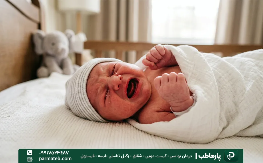 جوش مقعدی در نوزادان