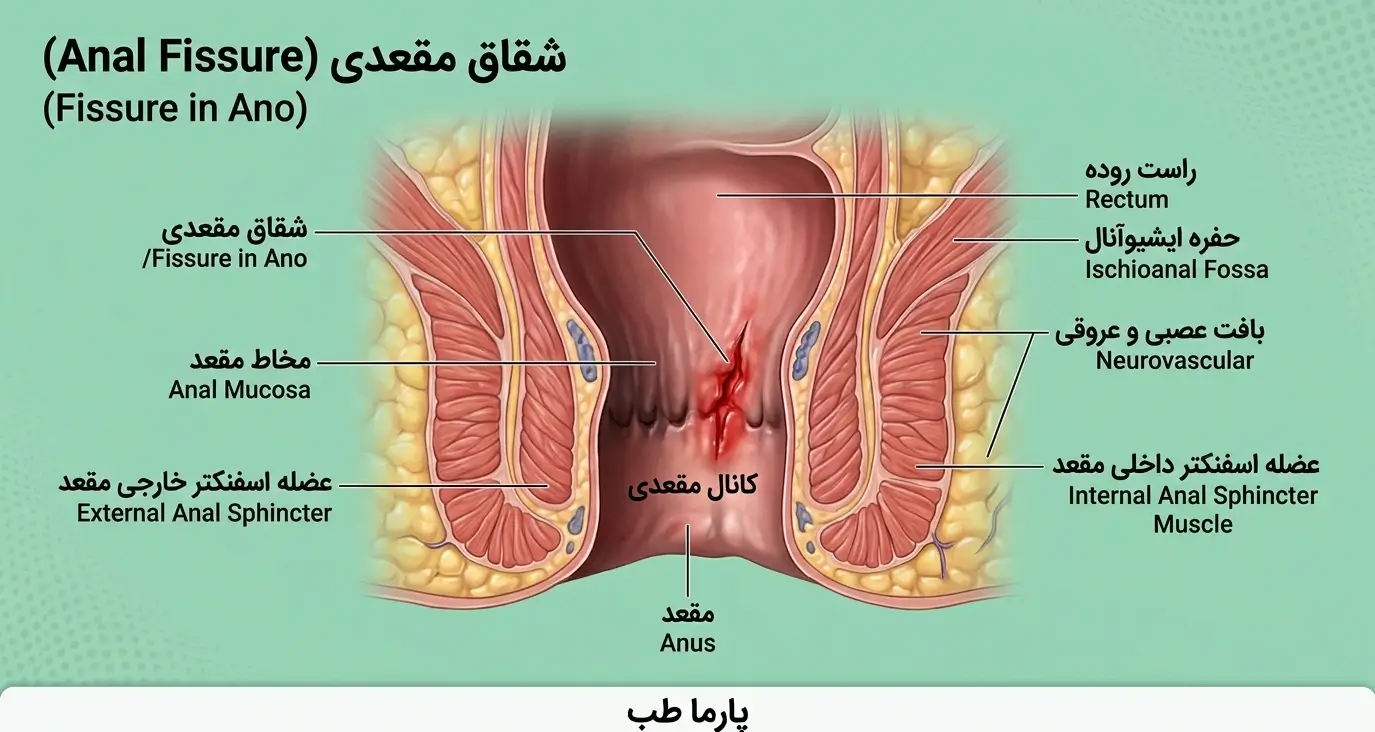 درمان فیشر یا شقاق مقعدی