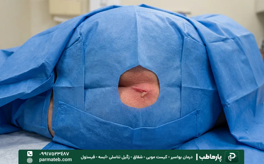 فیستول مقعدی آقایان