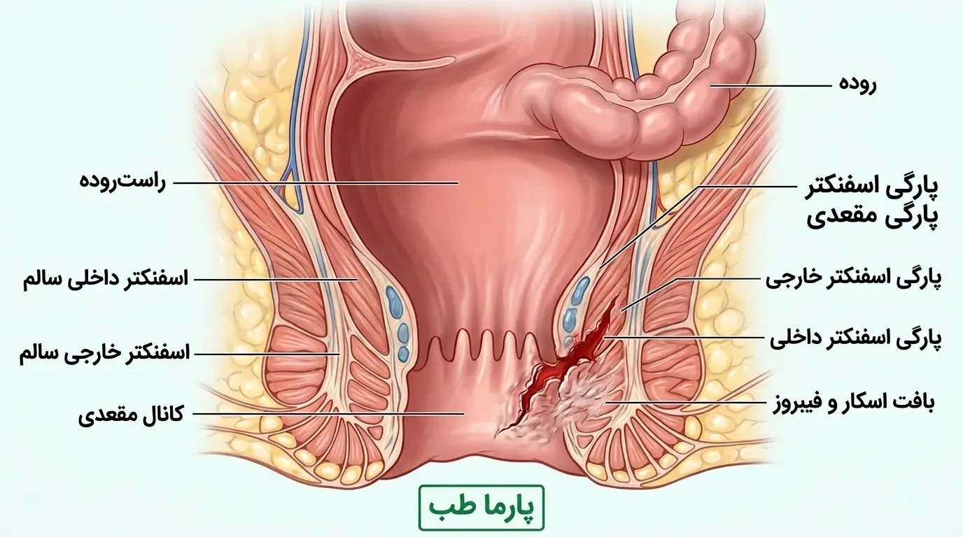 پارگی اسفنکتر مقعدی