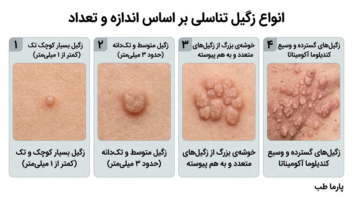 انواع زگیل تناسلی براساس اندازه و تعداد