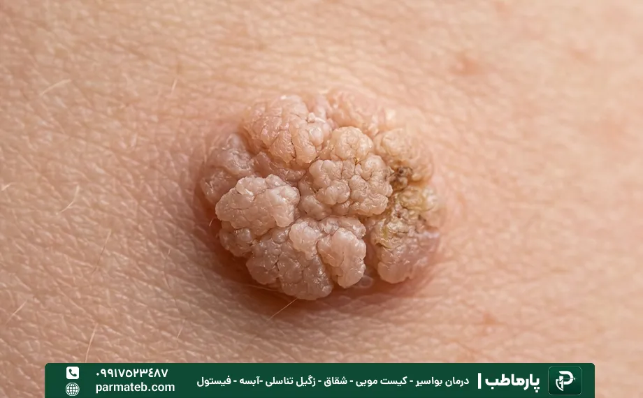 زگیل تناسلی گل کلمی