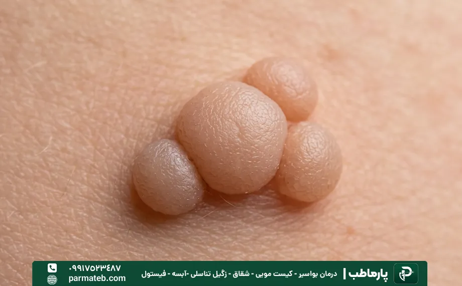 نوع برجسته