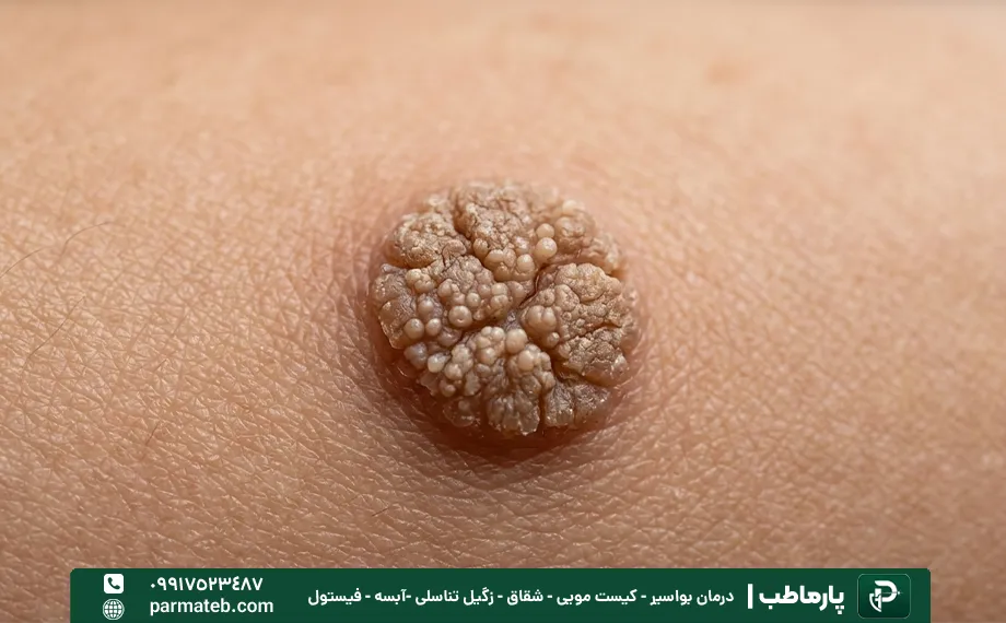 زگیل تناسلی برجسته