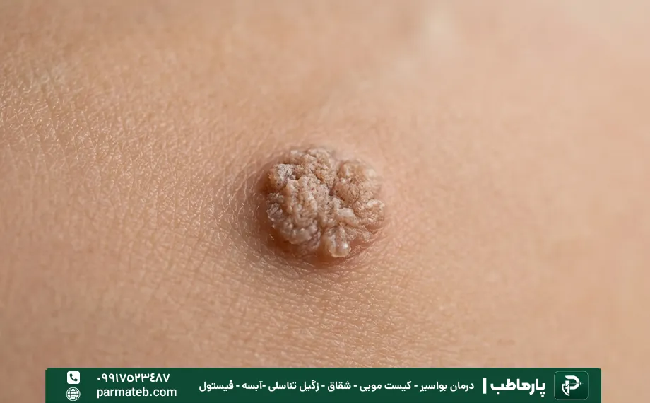 عکس زگیل تناسلی در دختران مجرد