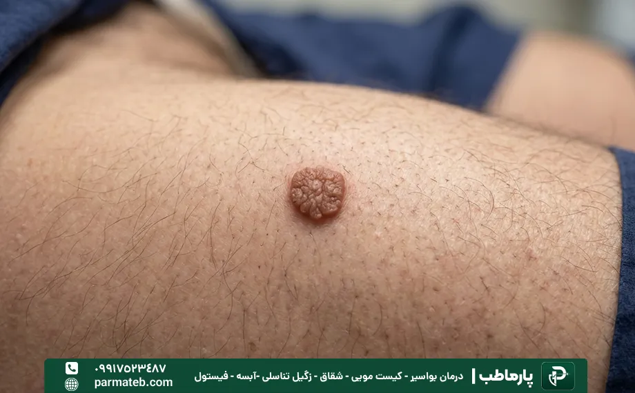 زگیل تناسلی در کشاله ران آقایان