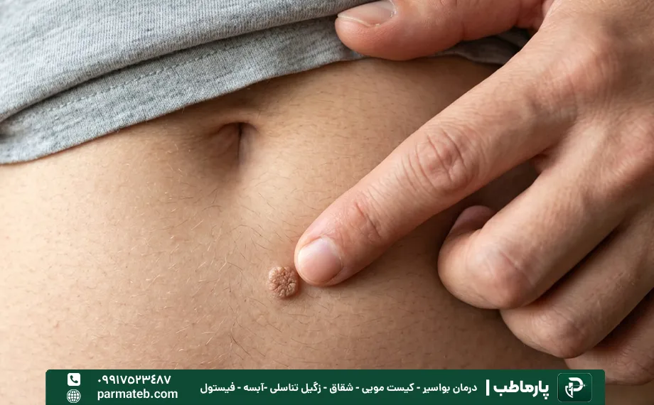 آیا با دست زدن به زگیل تناسلی باعث انتقال میشود؟